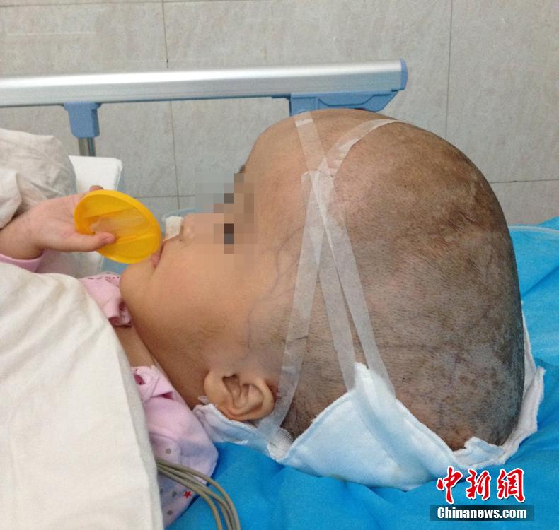 В китайской провинции Хунань успешно проведена первая в мире операция по «уменьшению головы»