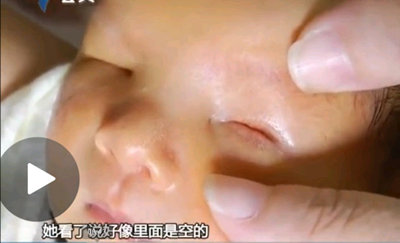 Ребенок без глаз появился на свет в Гуанчжоу